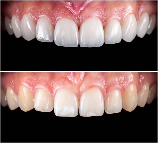 RĂNG SỨ NGUYÊN KHỐI LÀ GÌ?